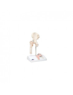 Frattura del femore e...