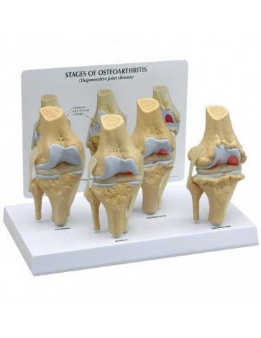 Stadi di osteoartrite dell'articolazione del ginocchio (4 stadi) 3B Scientific 1019502