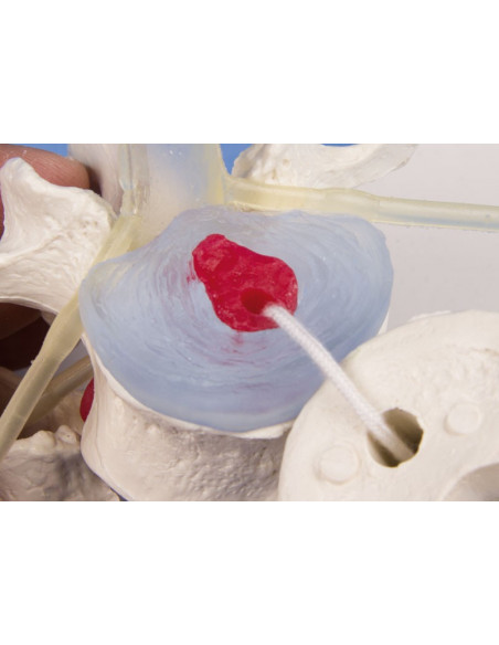 Erler Zimmer modello anatomico didattico di 3 vertebre lombari con prolasso, su stand 4047