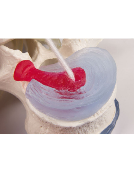 Erler Zimmer modello anatomico didattico di 3 vertebre lombari con prolasso, su stand 4047